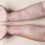 Early psoriasis intervention can save lives