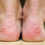 Understanding and Preventing Foot Blisters: Insights From M Maddocks Inc