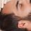 Understanding Alopecia and Hair Loss Solutions