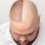 Hair Transplants and Related Procedures: What to Expect