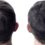 Alopecia and Hair Restoration Treatments